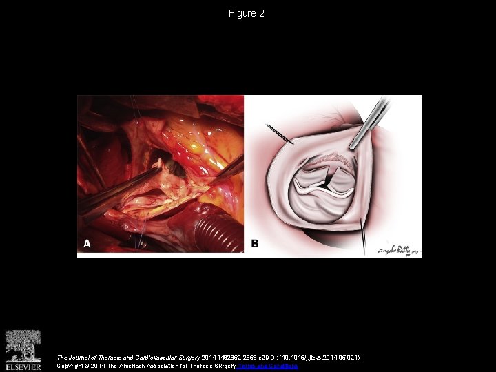 Figure 2 The Journal of Thoracic and Cardiovascular Surgery 2014 1482862 -2868. e 2