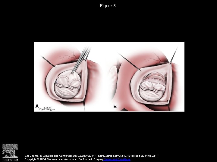 Figure 3 The Journal of Thoracic and Cardiovascular Surgery 2014 1482862 -2868. e 2