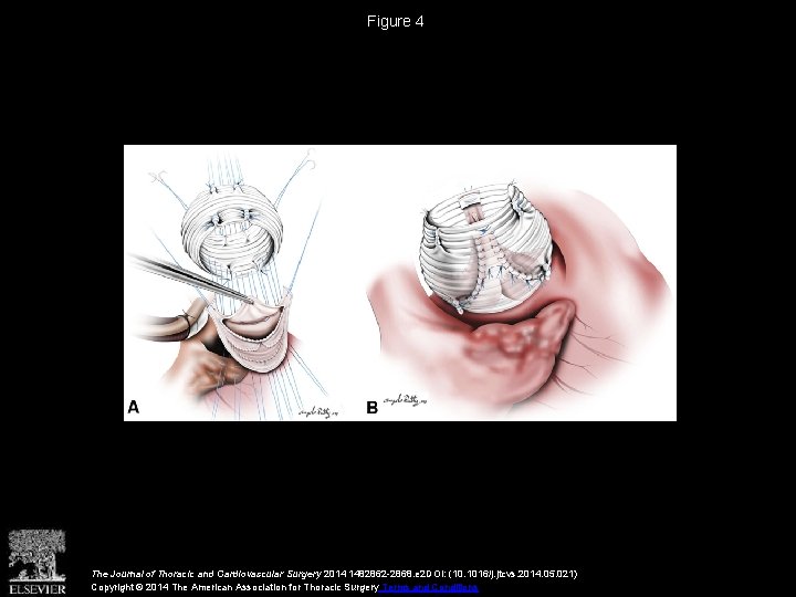 Figure 4 The Journal of Thoracic and Cardiovascular Surgery 2014 1482862 -2868. e 2
