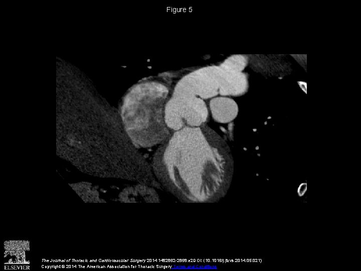 Figure 5 The Journal of Thoracic and Cardiovascular Surgery 2014 1482862 -2868. e 2