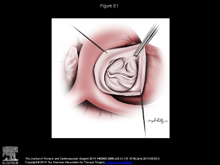 Figure E 1 The Journal of Thoracic and Cardiovascular Surgery 2014 1482862 -2868. e