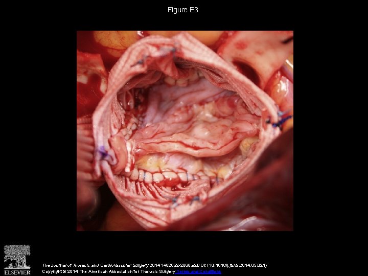 Figure E 3 The Journal of Thoracic and Cardiovascular Surgery 2014 1482862 -2868. e