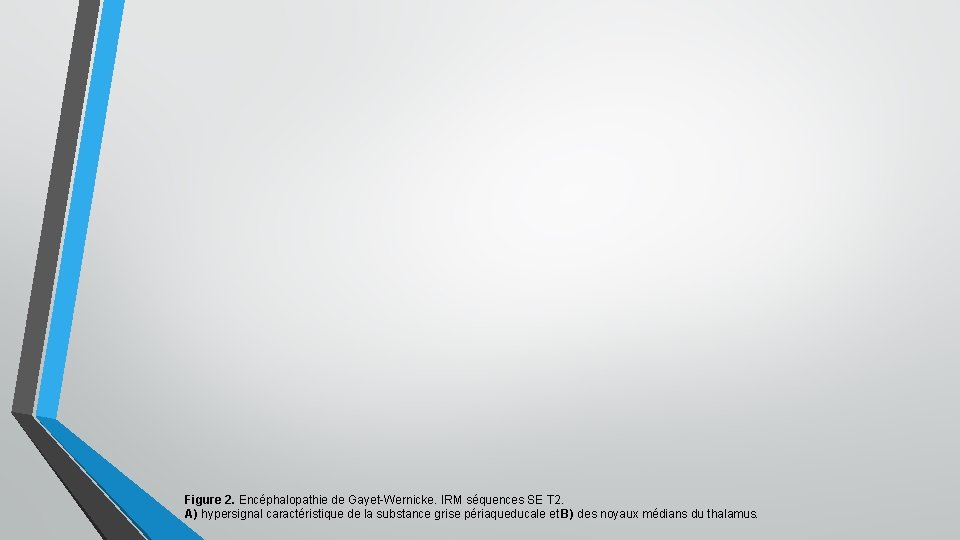 Figure 2. Encéphalopathie de Gayet-Wernicke. IRM séquences SE T 2. A) hypersignal caractéristique de Figure 2. Encéphalopathie de Gayet-Wernicke. IRM séquences SE T 2. A) hypersignal caractéristique de