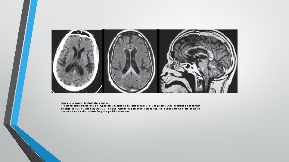 Figure 3. Syndrome de Marchiafava-Bignami. A) Scanner cérébral sans injection : hypodensité du splénium
