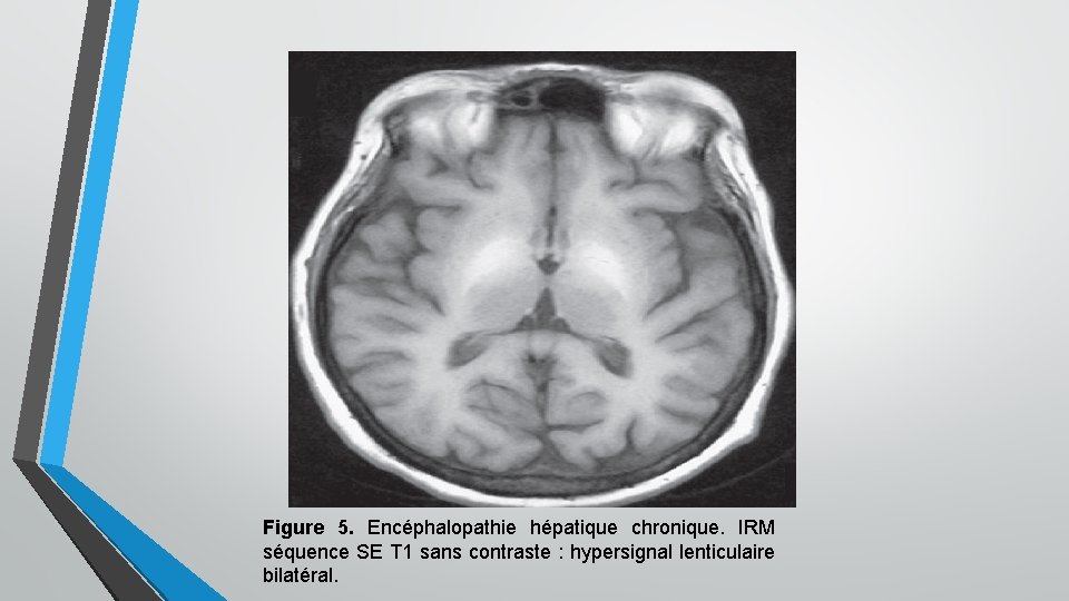 Figure 5. Encéphalopathie hépatique chronique. IRM séquence SE T 1 sans contraste : hypersignal Figure 5. Encéphalopathie hépatique chronique. IRM séquence SE T 1 sans contraste : hypersignal