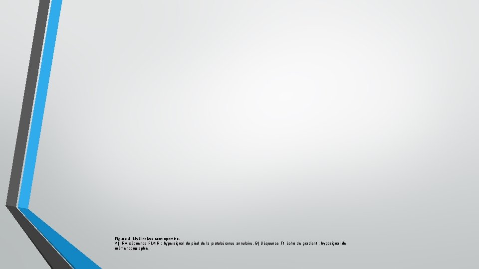Figure 4. Myélinolyse centropontine. A) IRM séquence FLAIR : hypersignal du pied de la Figure 4. Myélinolyse centropontine. A) IRM séquence FLAIR : hypersignal du pied de la