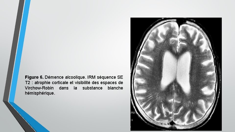 Figure 6. Démence alcoolique. IRM séquence SE T 2 : atrophie corticale et visibilité Figure 6. Démence alcoolique. IRM séquence SE T 2 : atrophie corticale et visibilité