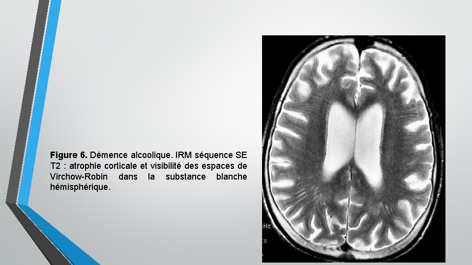 Figure 6. Démence alcoolique. IRM séquence SE T 2 : atrophie corticale et visibilité