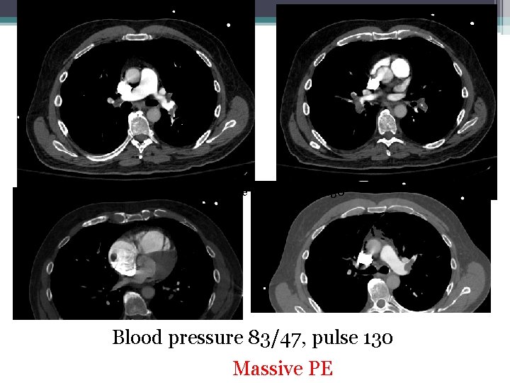 Blood pressure 83/47, pulse 130 Massive PE 