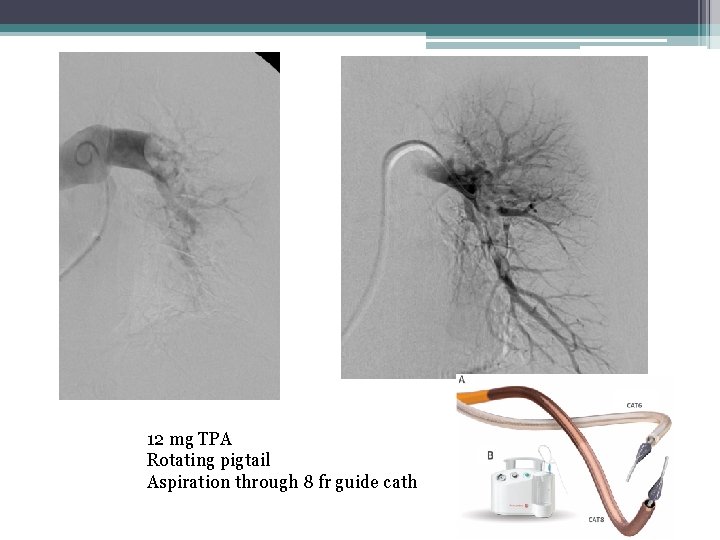 12 mg TPA Rotating pigtail Aspiration through 8 fr guide cath 