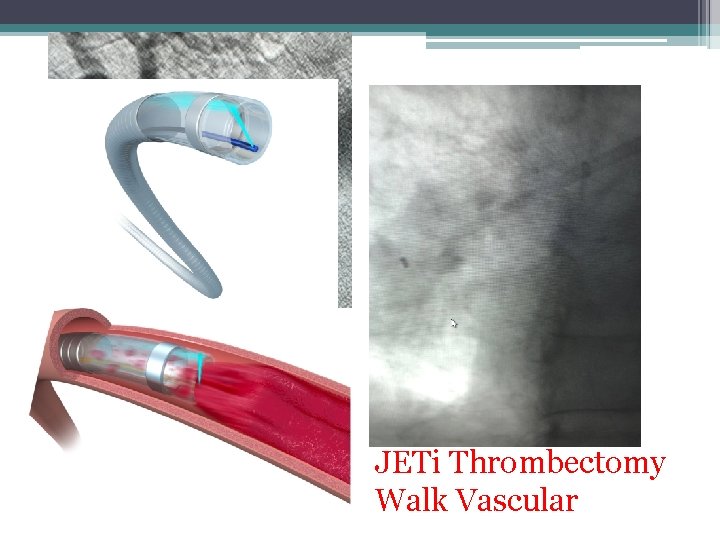 JETi Thrombectomy Walk Vascular 