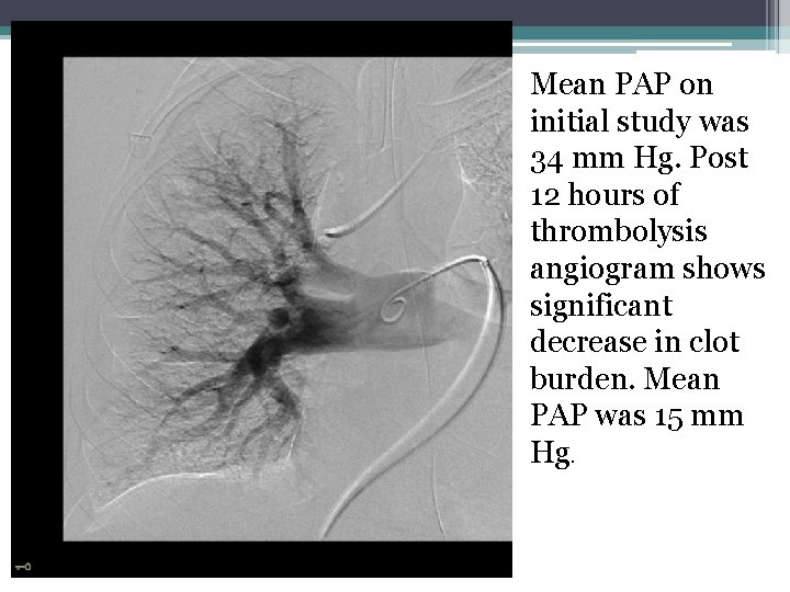 Mean PAP on initial study was 34 mm Hg. Post 12 hours of thrombolysis