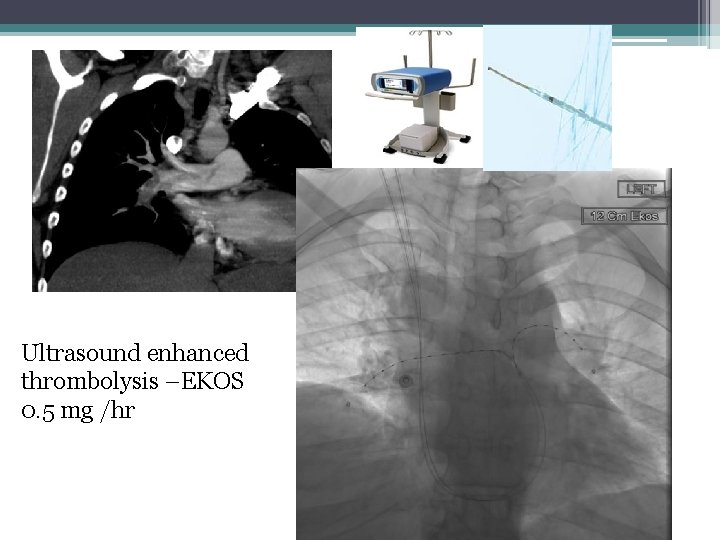 Ultrasound enhanced thrombolysis –EKOS 0. 5 mg /hr 