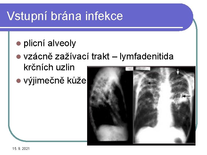 Vstupní brána infekce l plicní alveoly l vzácně zažívací trakt – lymfadenitida krčních uzlin