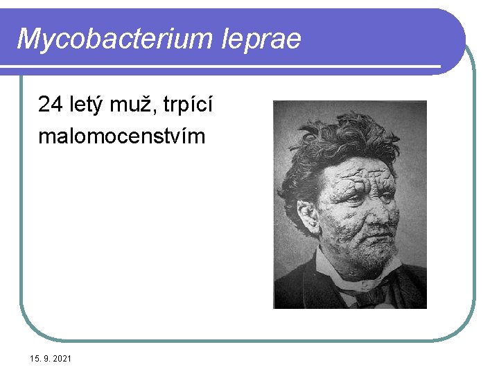 Mycobacterium leprae 24 letý muž, trpící malomocenstvím 15. 9. 2021 