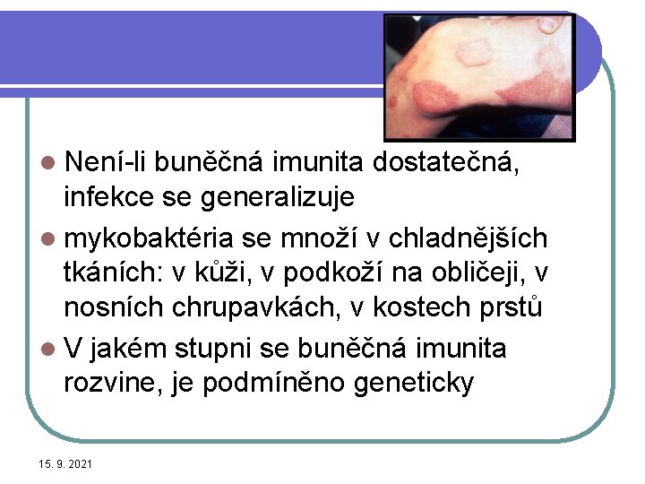 l Není-li buněčná imunita dostatečná, infekce se generalizuje l mykobaktéria se množí v chladnějších