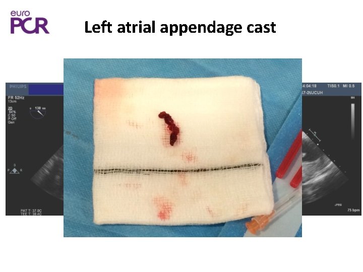 Left atrial appendage cast 