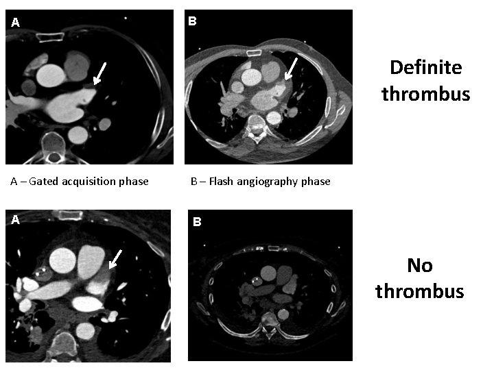 A B Definite thrombus A – Gated acquisition phase B – Flash angiography phase