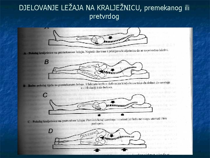 DJELOVANJE LEŽAJA NA KRALJEŽNICU, premekanog ili pretvrdog 