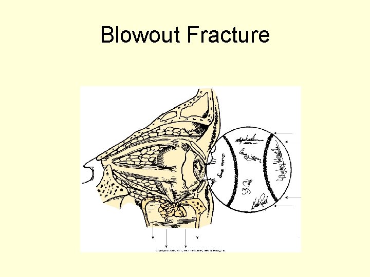 Blowout Fracture 