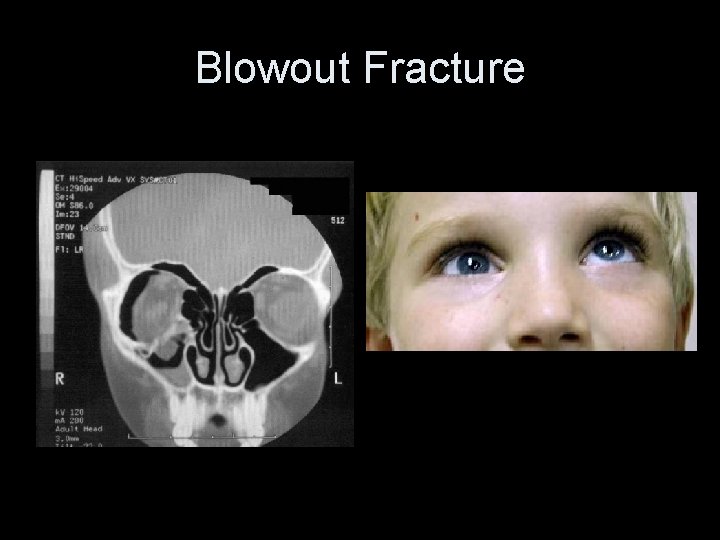 Blowout Fracture 