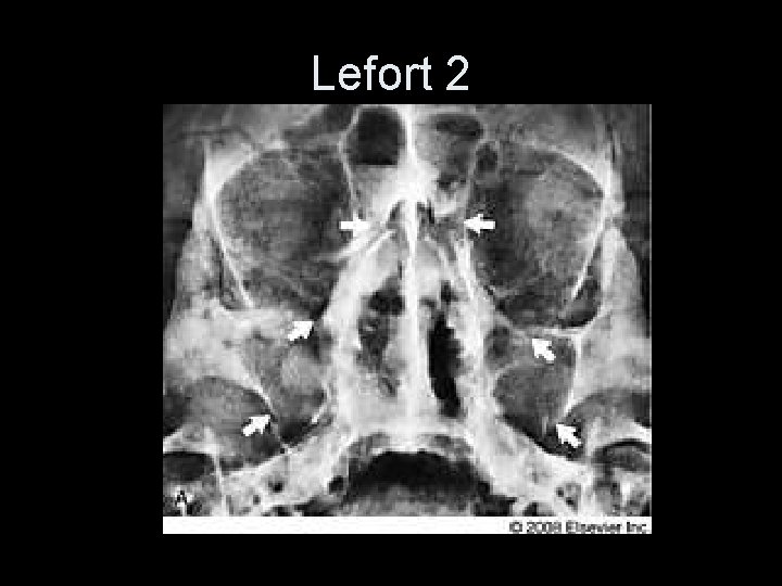 Lefort 2 