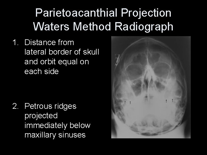 Parietoacanthial Projection Waters Method Radiograph 1. Distance from lateral border of skull and orbit