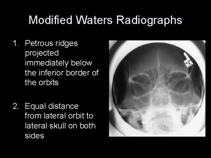 Modified Waters Radiographs 1. Petrous ridges projected immediately below the inferior border of the
