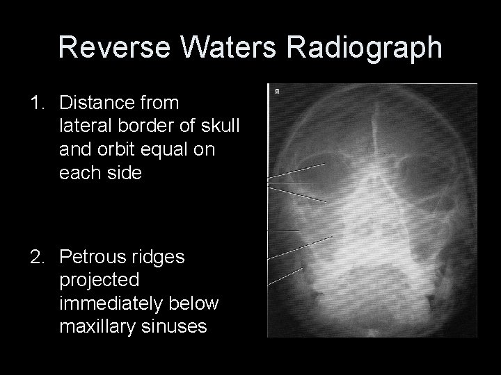 Reverse Waters Radiograph 1. Distance from lateral border of skull and orbit equal on