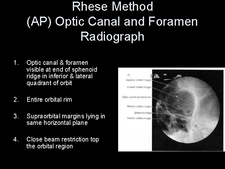 Rhese Method (AP) Optic Canal and Foramen Radiograph 1. Optic canal & foramen visible