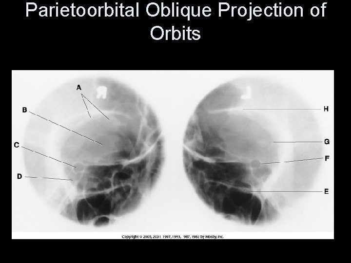 Parietoorbital Oblique Projection of Orbits 
