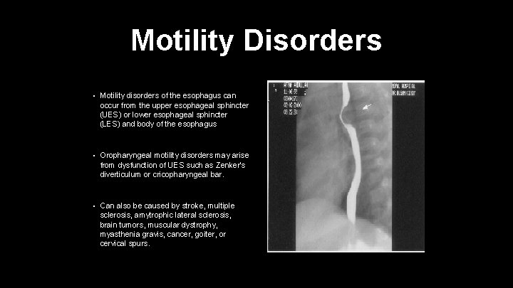 Motility Disorders • Motility disorders of the esophagus can occur from the upper esophageal