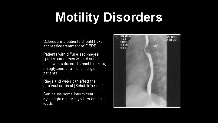 Motility Disorders • Scleroderma patients should have aggressive treatment of GERD • Patients with