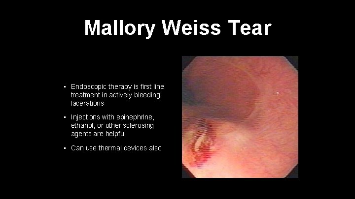 Mallory Weiss Tear • Endoscopic therapy is first line treatment in actively bleeding lacerations