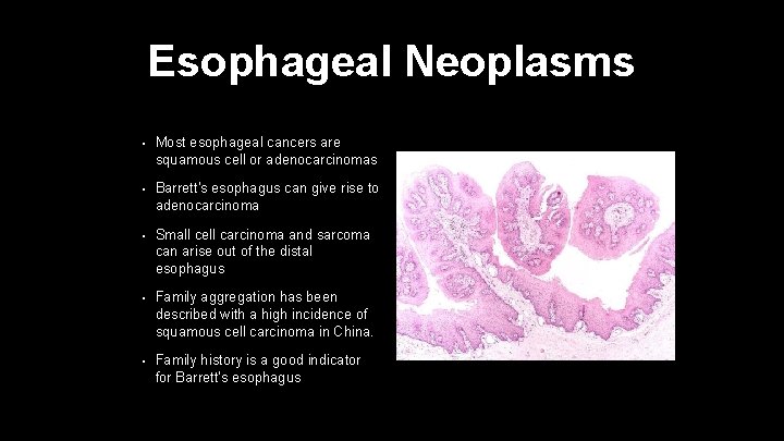Esophageal Neoplasms • Most esophageal cancers are squamous cell or adenocarcinomas • Barrett's esophagus