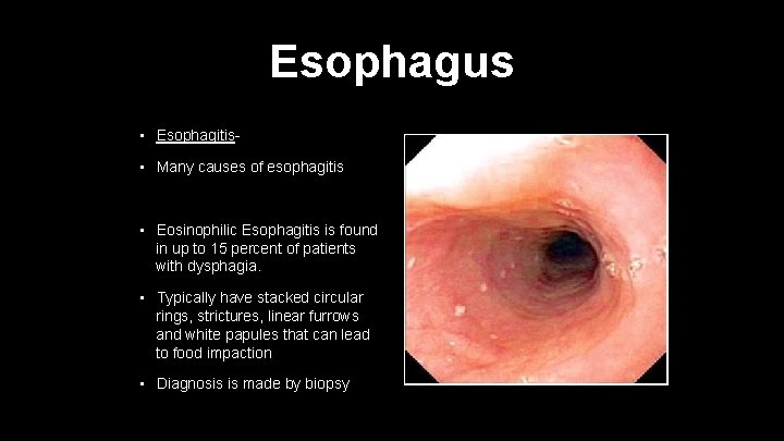 Esophagus • Esophagitis- • Many causes of esophagitis • Eosinophilic Esophagitis is found in