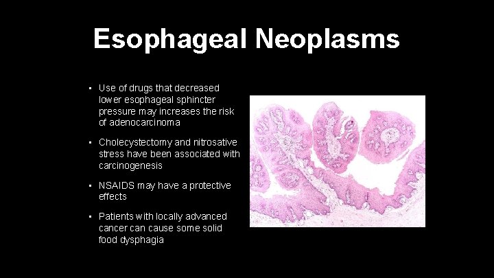 Esophageal Neoplasms • Use of drugs that decreased lower esophageal sphincter pressure may increases