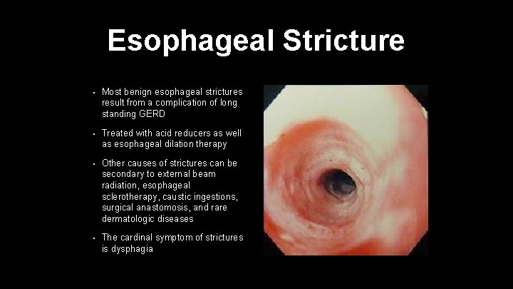 Esophageal Stricture • Most benign esophageal strictures result from a complication of long standing