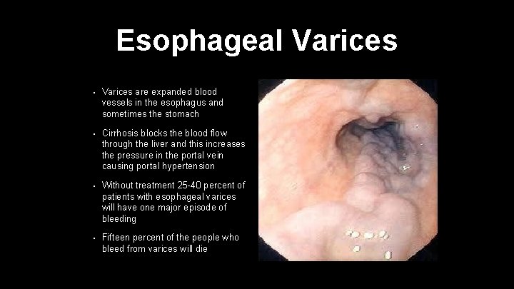 Esophageal Varices • Varices are expanded blood vessels in the esophagus and sometimes the