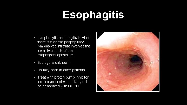 Esophagitis • Lymphocytic esophagitis is when there is a dense peripapillary lymphocytic infiltrate involves