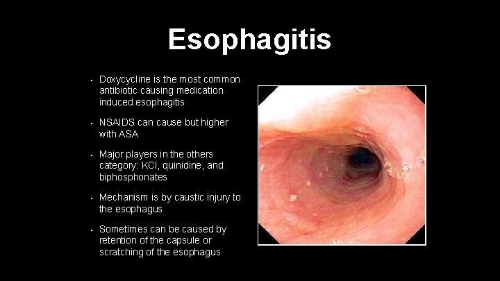 Esophagitis • Doxycycline is the most common antibiotic causing medication induced esophagitis • NSAIDS