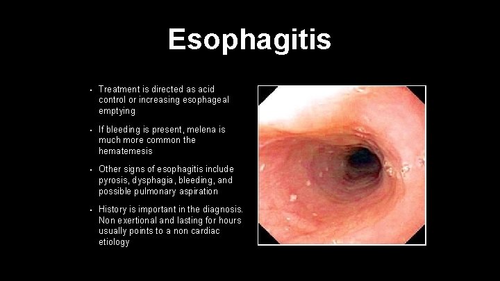 Esophagitis • Treatment is directed as acid control or increasing esophageal emptying • If