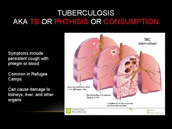 TUBERCULOSIS AKA TB OR PHTHISIS OR CONSUMPTION Symptoms include persistent cough with phlegm or