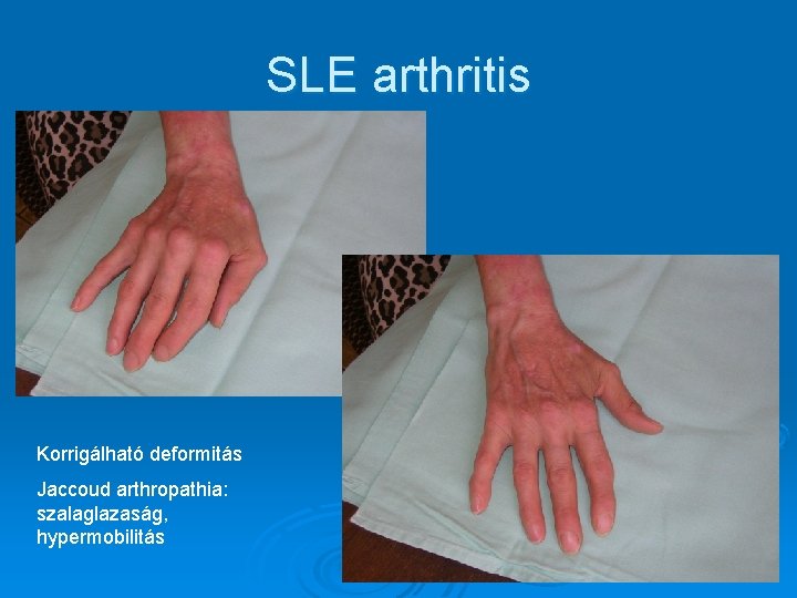 SLE arthritis Korrigálható deformitás Jaccoud arthropathia: szalaglazaság, hypermobilitás SLE arthritis Korrigálható deformitás Jaccoud arthropathia: szalaglazaság, hypermobilitás
