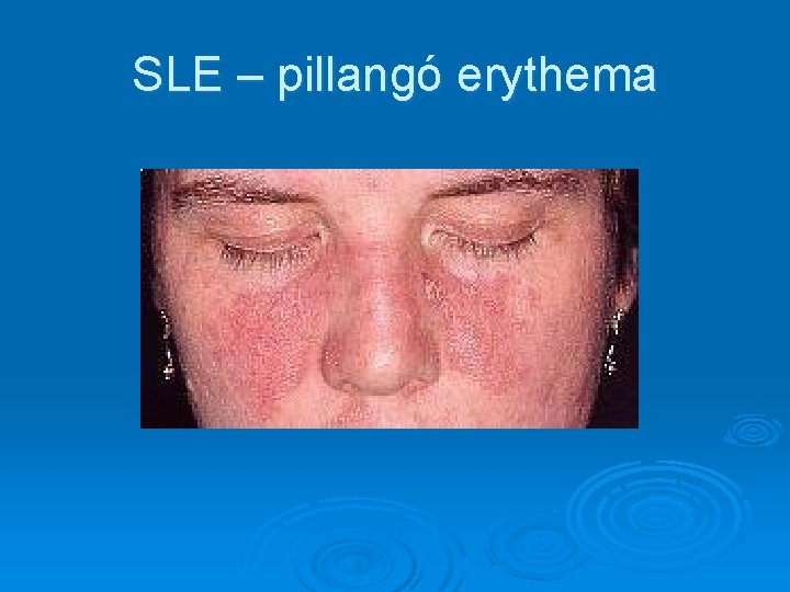 SLE – pillangó erythema SLE – pillangó erythema