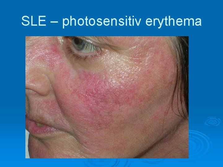 SLE – photosensitiv erythema SLE – photosensitiv erythema