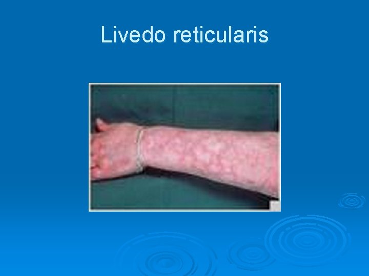 Livedo reticularis Livedo reticularis