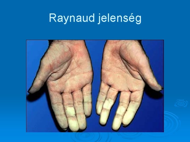 Raynaud jelenség Raynaud jelenség