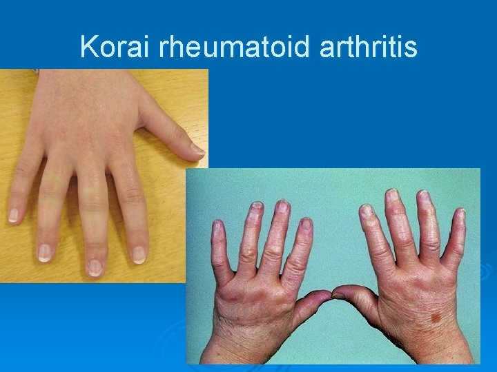 Korai rheumatoid arthritis Korai rheumatoid arthritis