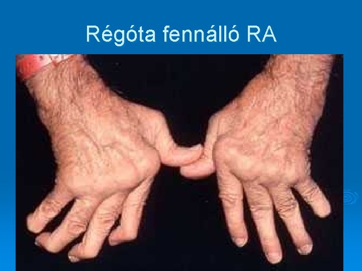 Régóta fennálló RA Régóta fennálló RA